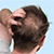 Male Pattern Baldness Symptoms