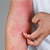 Eczema Symptoms icon