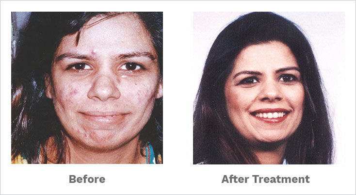 After homeopathic treatment, she got rid of acne and acne scars.