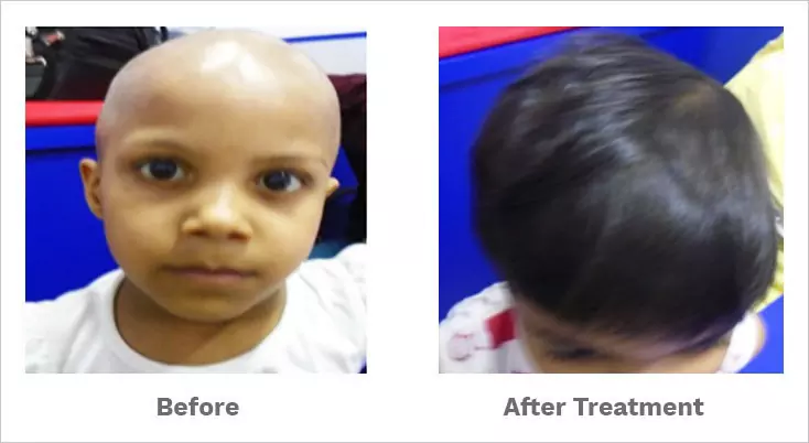 alopecia totalis treated by our hair specialist