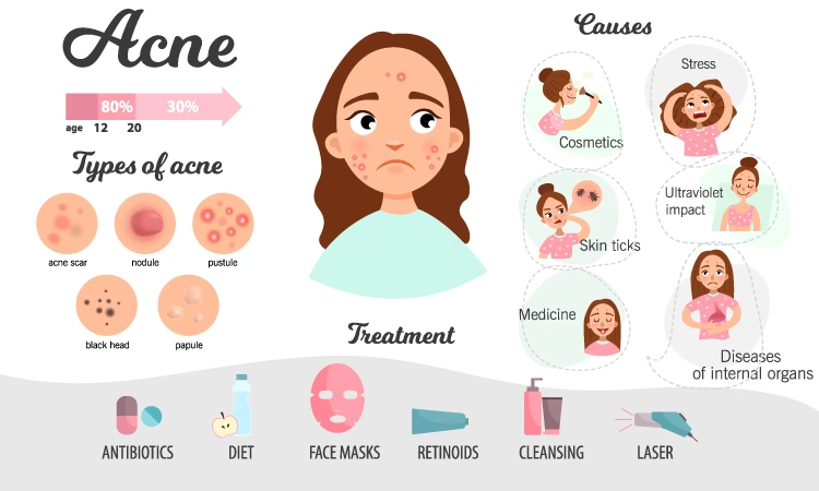 Top 13 commonly asked questions about acne