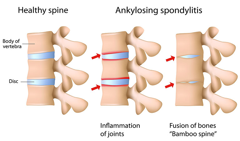 Can ankylosing spondylitis be cured by homeopathy