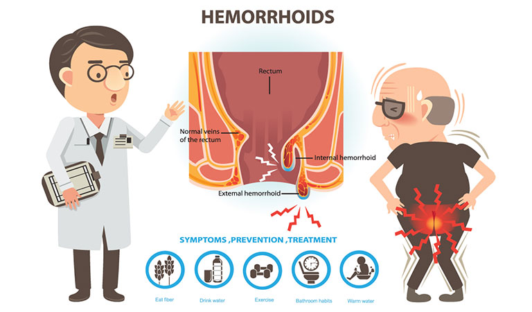 Can homeopathic treatment cure painful piles or hemorrhoids
