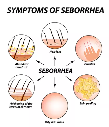 How does Seborrhoeic Dermatitis affect babies?