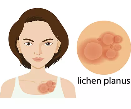 What is lichen planus classification?
