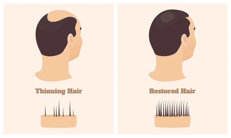 Ways to manage Male Pattern Baldness