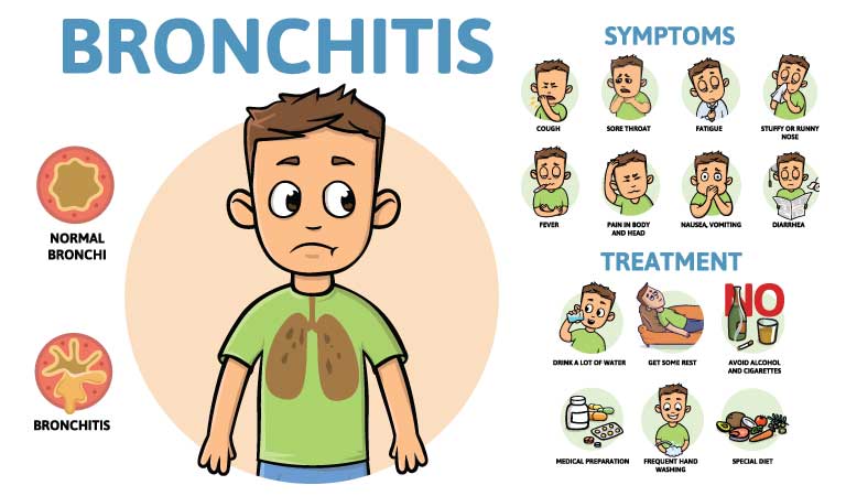 Exercise and bronchitis: Do they go together? 