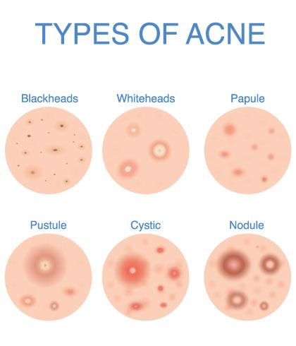 How to deal with sudden acne breakout on face?