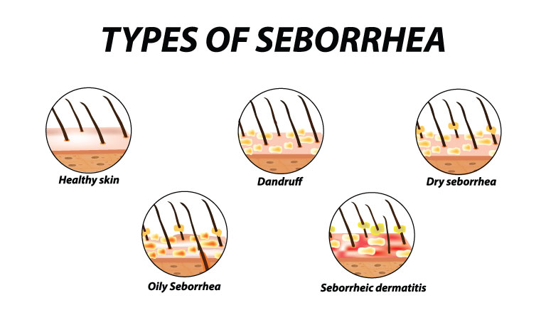 Seborrheic Dermatitis? Treat it with Homeopathy!