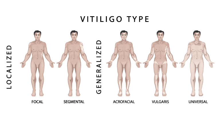 Seek Vitiligo treatment in homeopathy