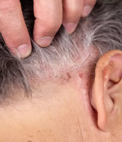 Home remedies for Scalp Psoriasis