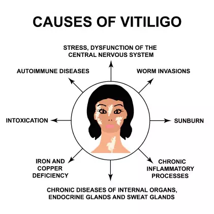 What Does Vitiligo Look Like?