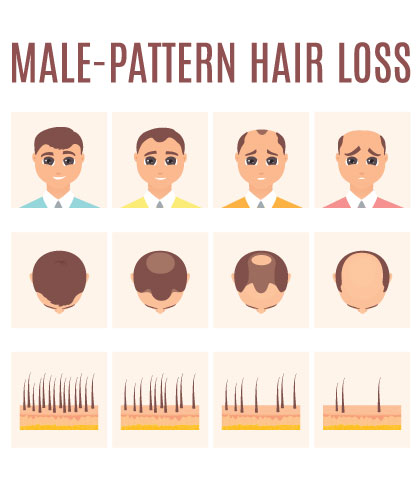 How to Beat Male Pattern Baldness?