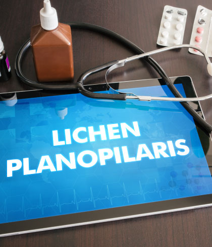 Lichen planus and hair loss