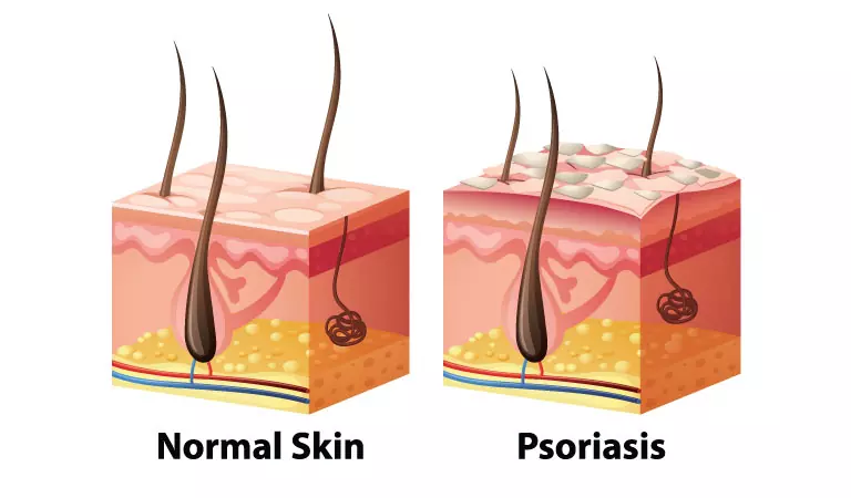 5 Tips to Calm Down Psoriasis on your Scalp