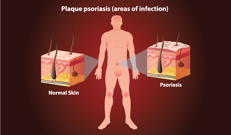 Psoriasis is more than just dry skin!