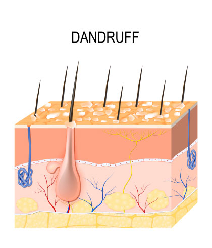 Can dandruff cause hair fall?
