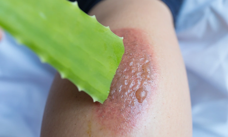 How to remove marks from skin infections?