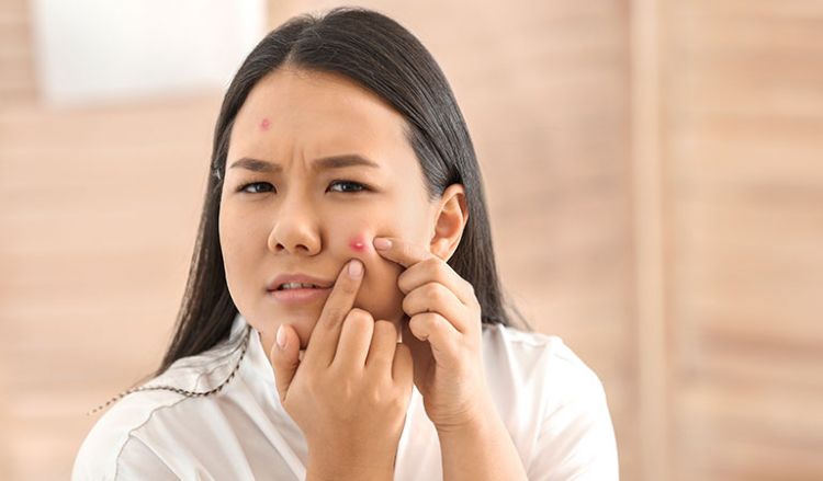 Get Rid Of Acne With Homeopathy Treatment
