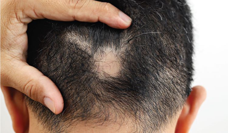 HOW TO LIVE WITH ALOPECIA AREATA?