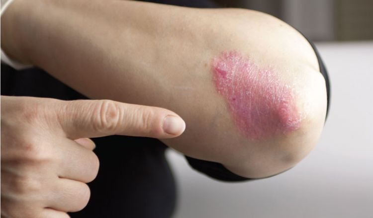 Psoriasis is more than just dry skin!