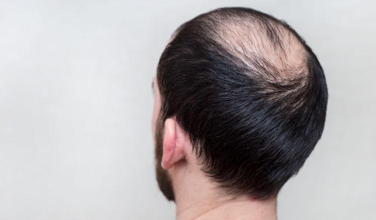 Know the Types of Alopecia