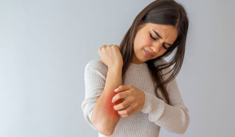 Homeopathy: Natural Treatment for Eczema