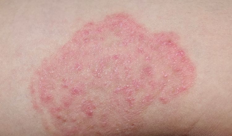 How to remove marks from skin infections?