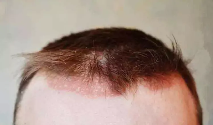 What I Wish Everyone Knew About Scalp Psoriasis And Homeopathy