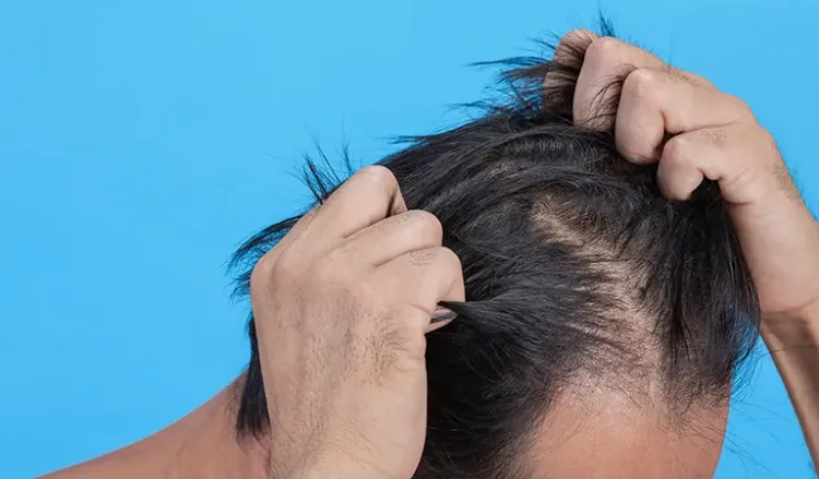 Homeopathy stops ‘hair pulling’ disorder effectively