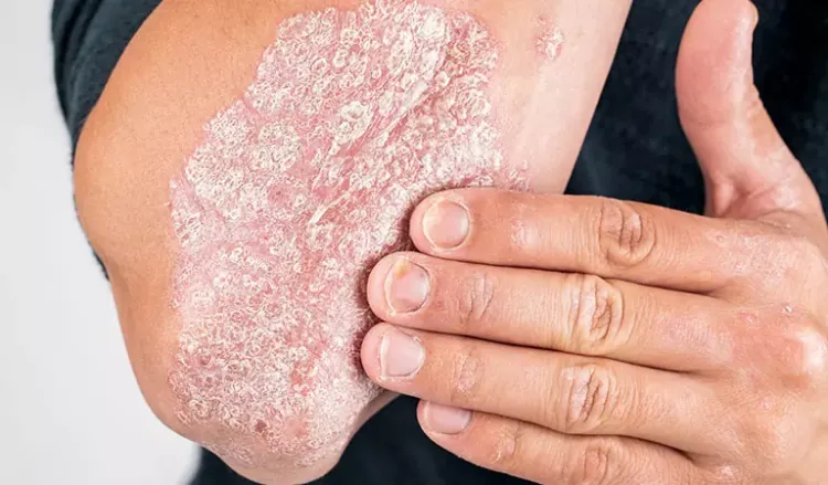 How Psoriasis can be treated by Homeopathy