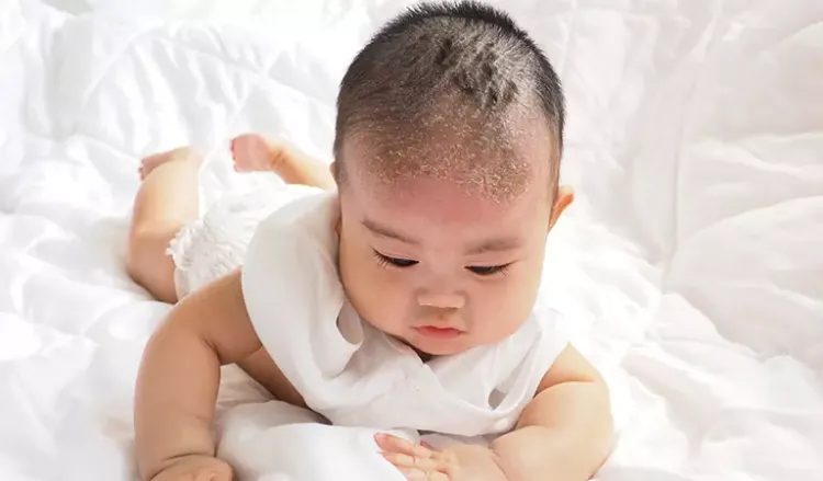 How does Seborrhoeic Dermatitis affect babies?