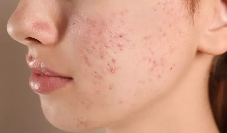 Reasons for acne on face