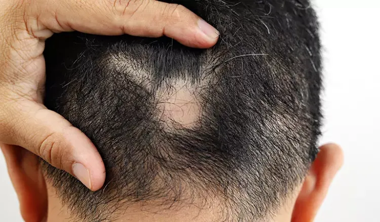 What causes patchy hair loss in men?
