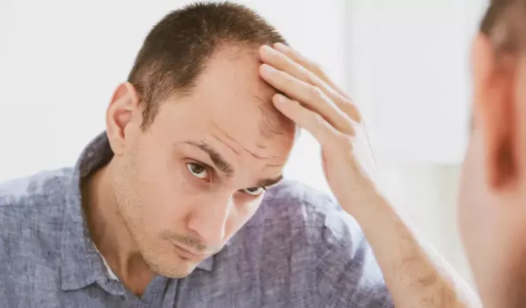How To Treat Male Pattern Baldness?