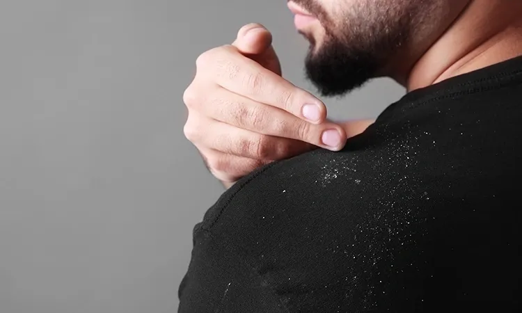 5 top questions asked by people who suffer from Dandruff
