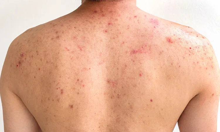 Here’s How You Can Control Body Acne