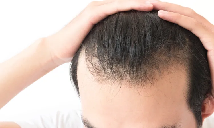Why is my Hairline Receding?
