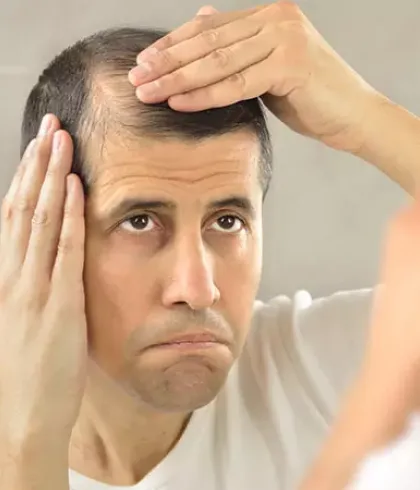 Things You Should Know About Male Pattern Baldness Dr Batras