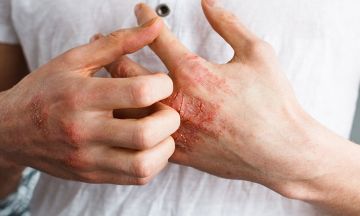 Read here to know how homeopathy treats eczema efficiently