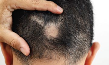 HOW TO LIVE WITH ALOPECIA AREATA?