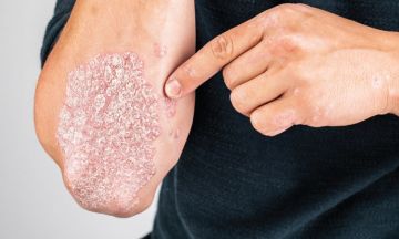 Which Is The Best Treatment For Psoriasis