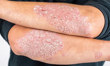 Skin rash? It might be Psoriasis
