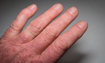 Can psoriasis lead to arthritis?