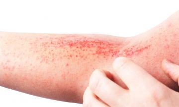 Eczema: Diagnosis & Treatments