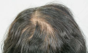 Thinning hair? Choose Homeopathy