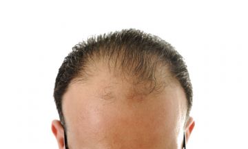 How to Beat Male Pattern Baldness?