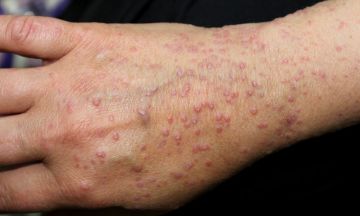 Can Lichen Planus be itchy?