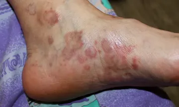 Can lichen planus cause itchy ankles?