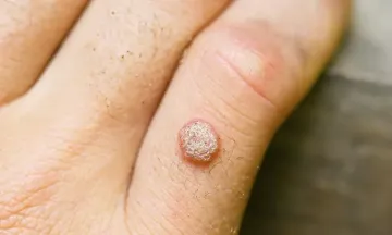 Causes of warts on hands